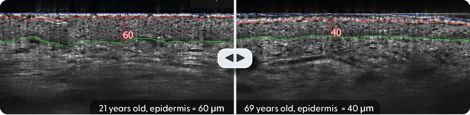 Quantifying Skin Aging In Vivo
